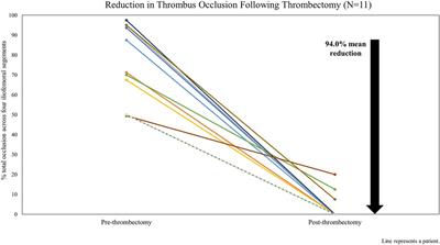 Single-center experience with the ClotTriever BOLD catheter for deep vein thrombosis percutaneous mechanical thrombectomy of the lower extremity
